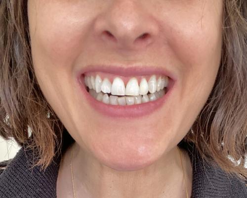 Emma L.'s GlorySmile Purple Toothpaste results