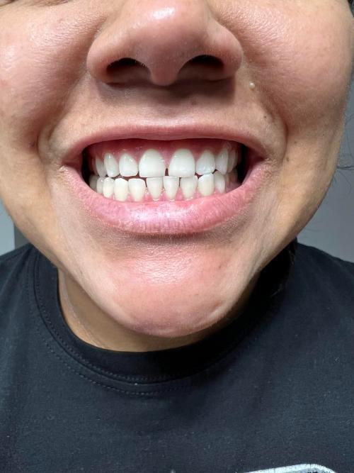 Isabella K.'s GlorySmile Purple Toothpaste results